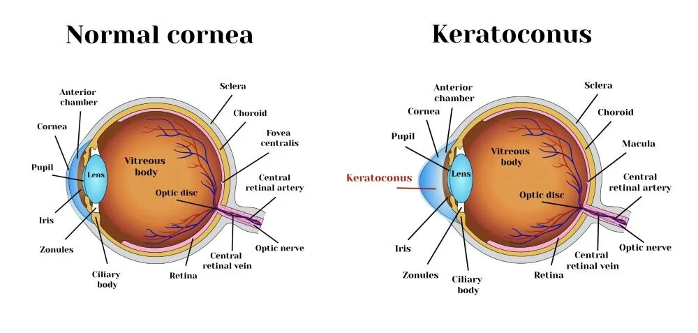 Keratokonus - göz hastalıkları